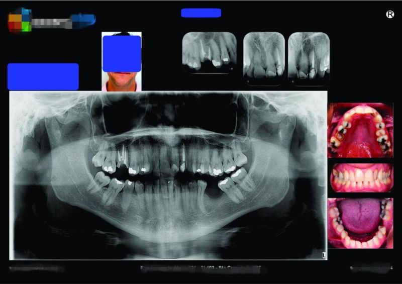 Professional Medical X-ray Film Blue Sensitive Dry Imager