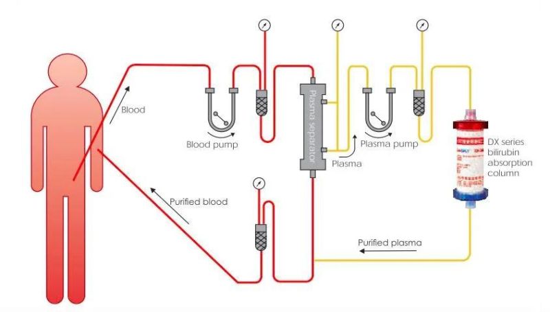 Highly Specific Bilirubin Absorption Column