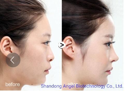 2ml Facial Sculpting Cross-Linked Dermal Filler for Facial Injection