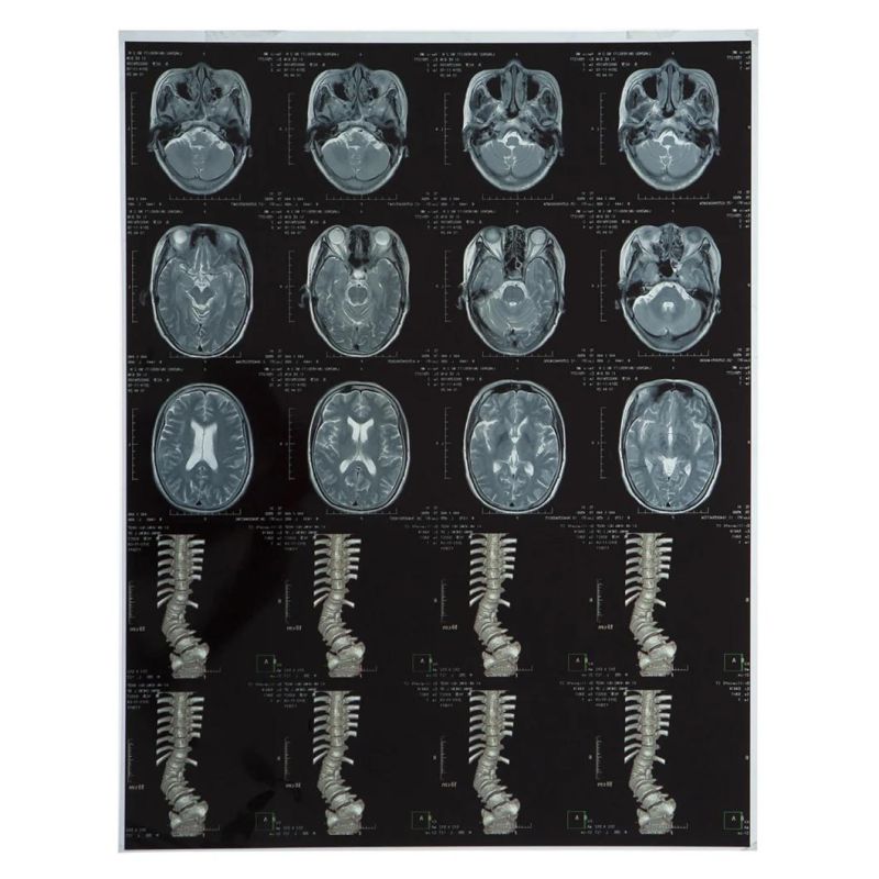 Radiology Department X-ray Blue Thermal Dry Films