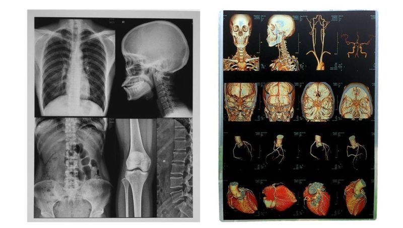 A4 and 11*14 X-ray Medical Film in Image Output Digital Printing