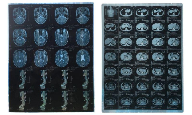 Hospital Use Radio Graphic Medical X-ray Film Imaging