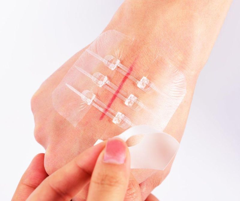 Medical Adhesive Disposable Wound Dressing Wound Closure Device Plaster