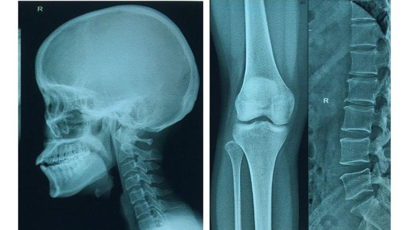 X Ray Film for CT MRI Cr Dr Chest Medical