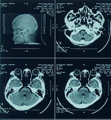 Hospital Medical X Ray Film 10X12 Blue