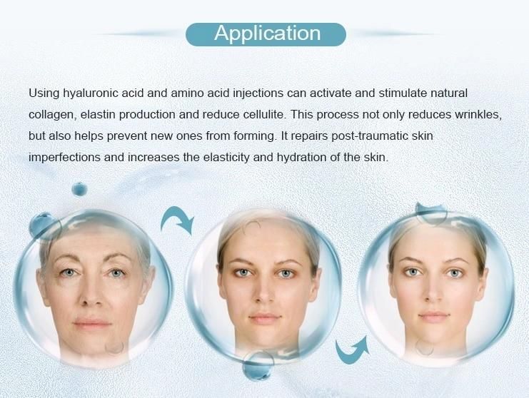 Forehead Lines Medical Beauty Injection Dermal Filler Injection Hyaluronic Acid