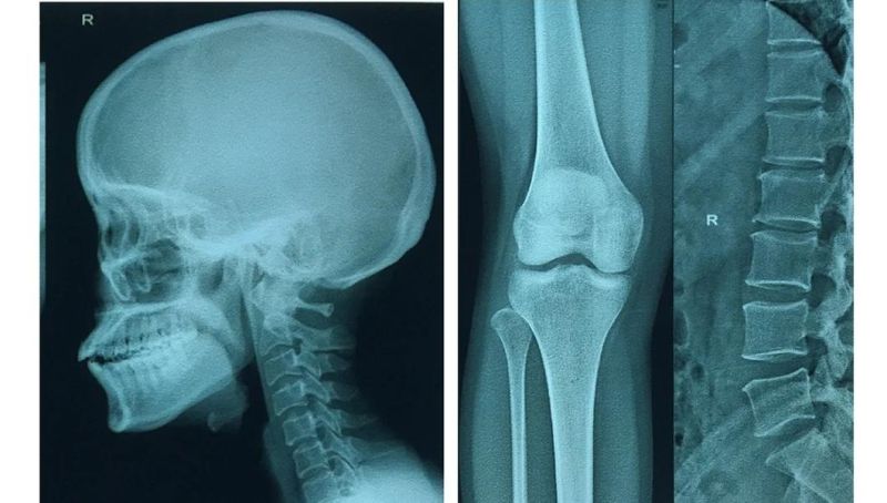 Thermal Neutron Imaging for Hospital Radiology