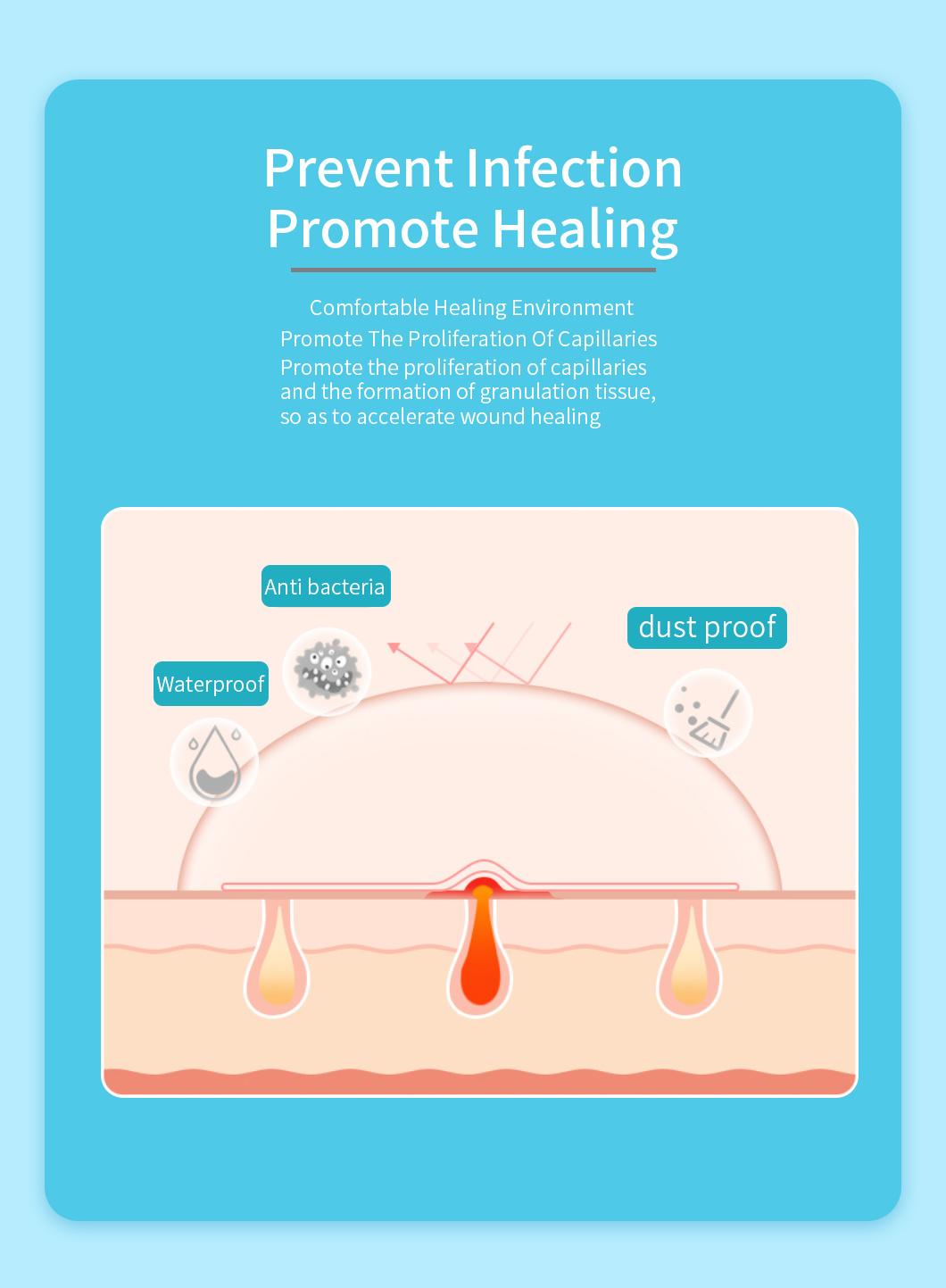 Hydrocolloid Dressing Impermeable to Bacterial Wound