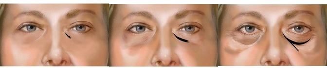 Anti Wrinkle Facial Dermal Fillers for Removing Eyes Circle Tear Grooves