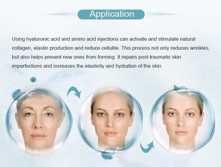 Medium Forehead Lines Facial Wrinkles Treatment Hyaluronic Acid Dermal Filler