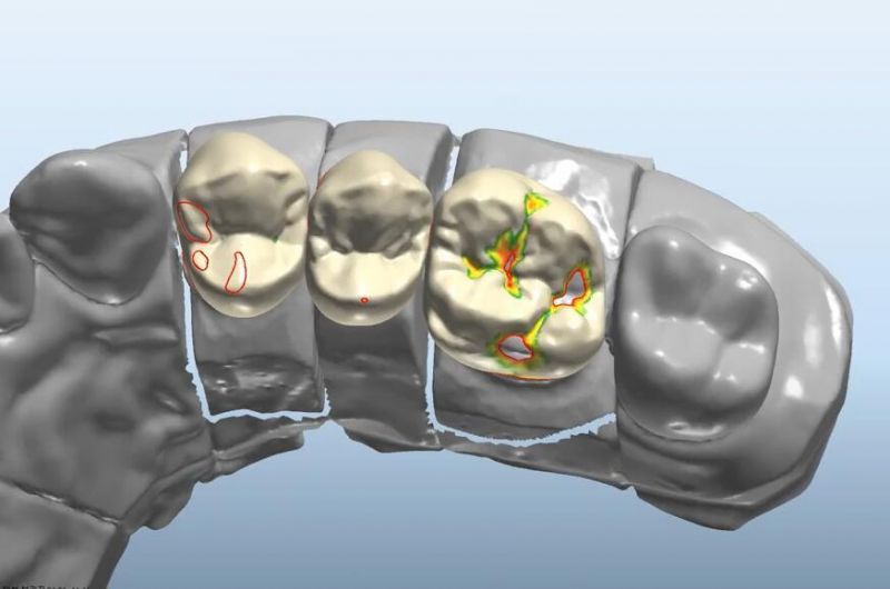 Dental Custom Abutment Full Partial Denture Smile Design Service