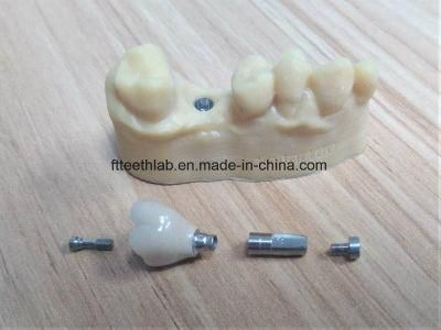 Precision Digital Dental Metal Ceramic Implant Crown