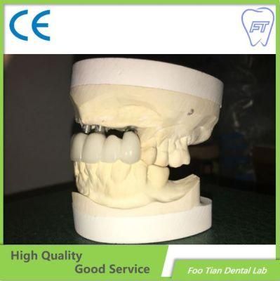 Manufacture Factory Aesthetic Dental Zirconium Bridges From China Dental Lab