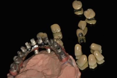 Screwed Implant Bridge with Custom Abutments