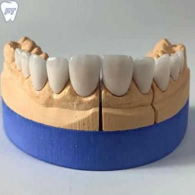 Porcelain Veneers Made in Shenzhen Dental Lab in Shenzhen China