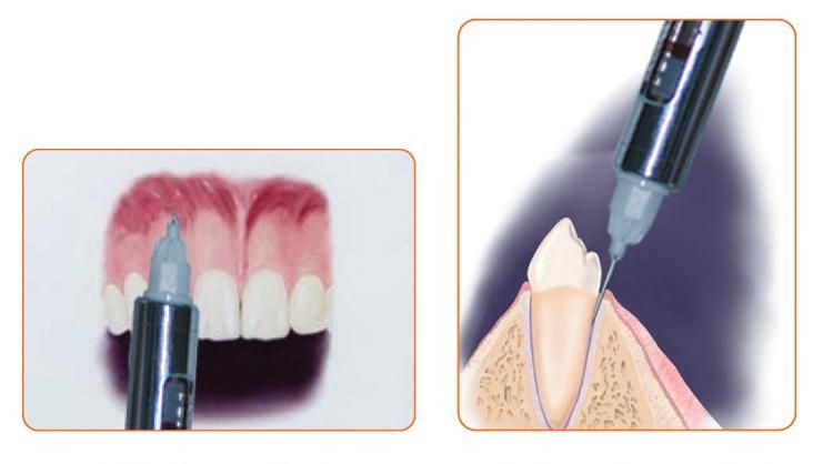 Easy II Dental Implant Anesthesia Orthodontic Equipment