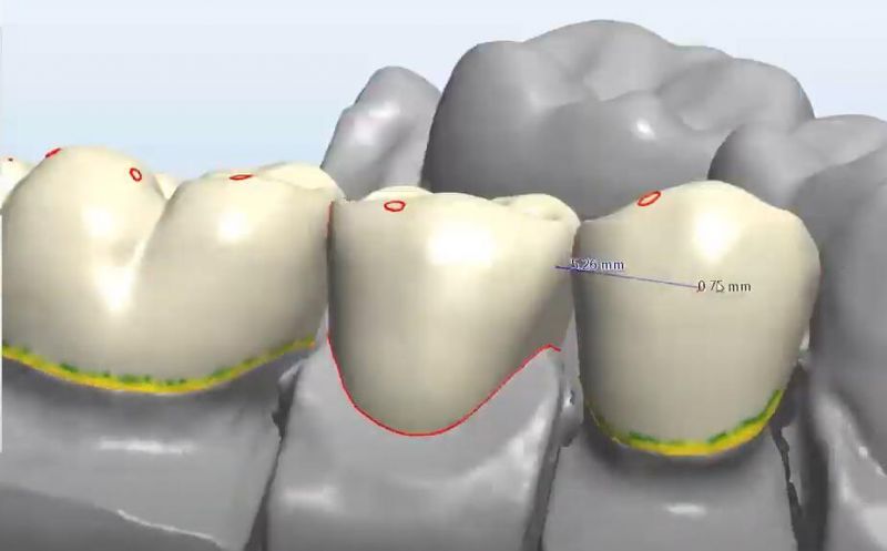 Dental Custom Abutment Full Partial Denture Smile Design Service