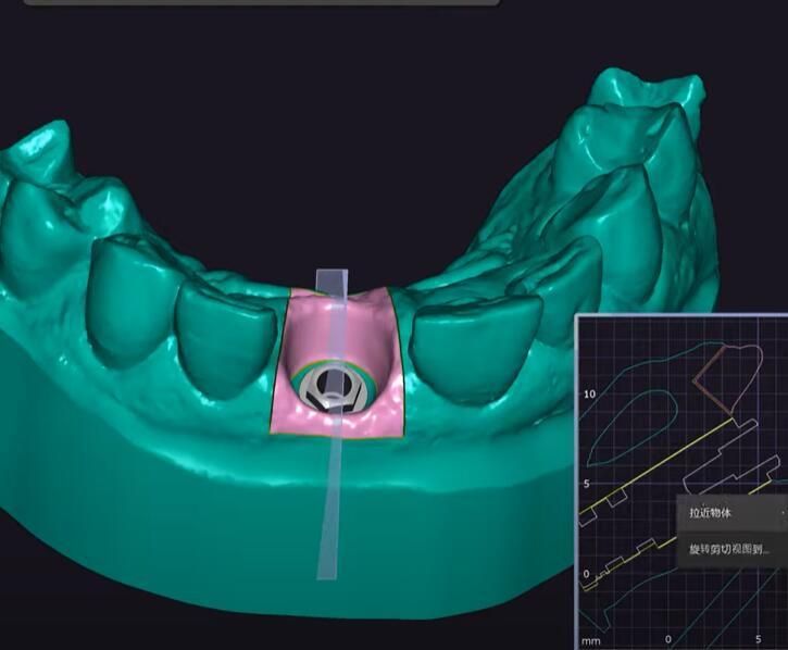 Dental 3shape Exocad Smile Design Service