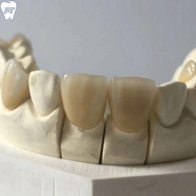 IPS Emax CAD Veneers Made in Chinese Dental Lab