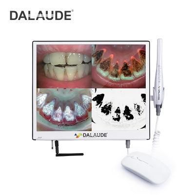 Ultraviolet Rays Intraoral Camera Caries Detection