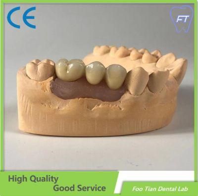 OEM Full Arch Metal Ceramic Implant Bridge with Cemented Retained