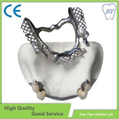 High Quality Removable Metal Framework Denture