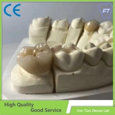 Emax Dental Inlays and Crowns with High Aesthetic