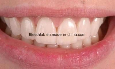 Affordable Full Ceramic Emax Veneers with High Aesthetics