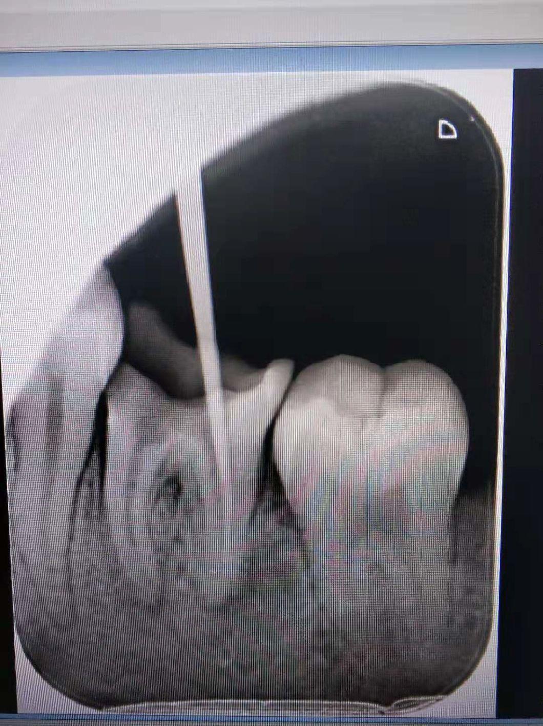 Root Canal Therapy Filming High Frequency X-ray Machine