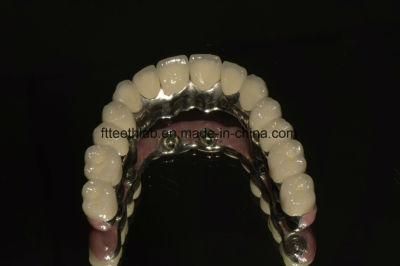 Dental Implant Supported Fullarch Porcelain Bridge