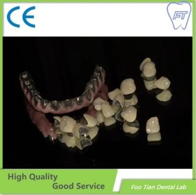 High Quality Dental Restoration Custom Abutment Denture Lab