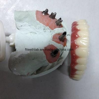 Full House Implant Bridge Made From Chinese Dental Lab
