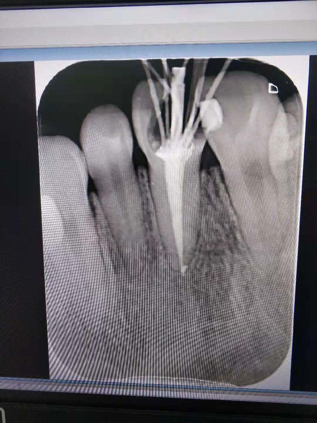 Root Canal Therapy Filming High Frequency X-ray Machine