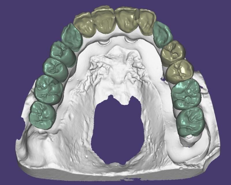 Orthodontic Products Dental Material Supplies CAD Cam Dental Implant Crown Made in China Dental Lab