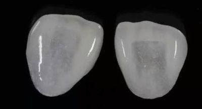 Dental Emax Veneers/ Non Prep Veneers From Midway Dental Lab