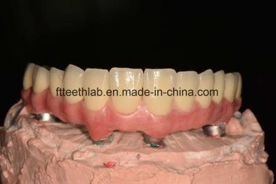 All on 4 Dental Implants Bridge