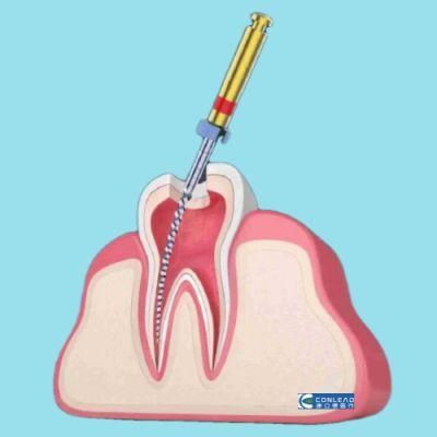 Looking for Good Root Canal Files? Here It Is.