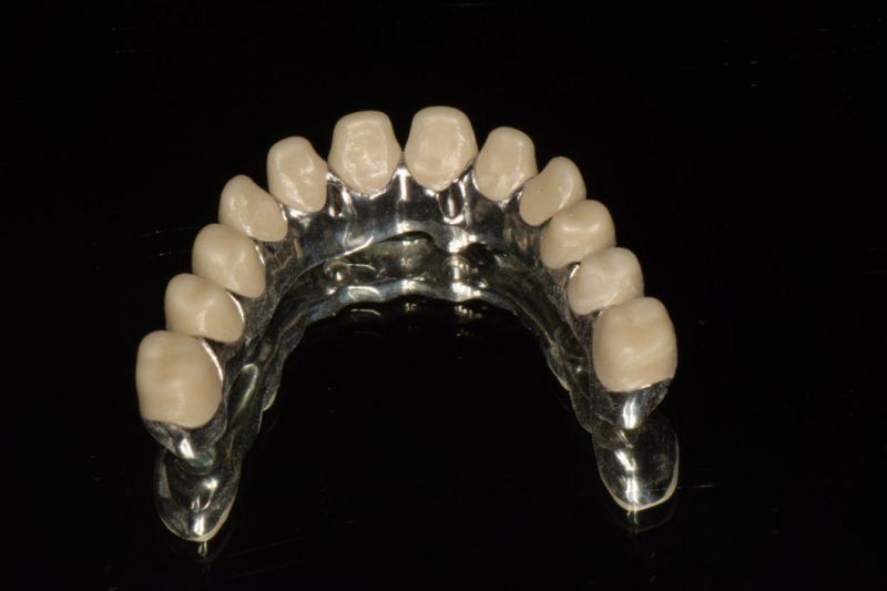 Orthodontic Products Dental Material Supplies Implant Emax Ceramic Inlay/Onlay From China Dental Lab