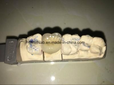 Metal Ceramic Crown with Transparent Incisal