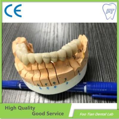 Hot Sale Dental Metal Ceramic Crown Made in Foo Tian Dental Lab in Shenzhen China