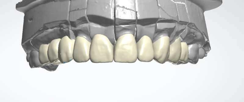 Dental Custom Abutment Full Partial Denture Smile Design Service