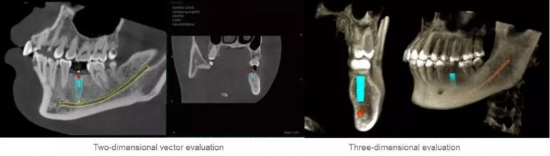 Hires 3D Dental Cbct Implant Inspection Equipment Implant Simulation Tmj Image New Cephalometric Seat Cbct