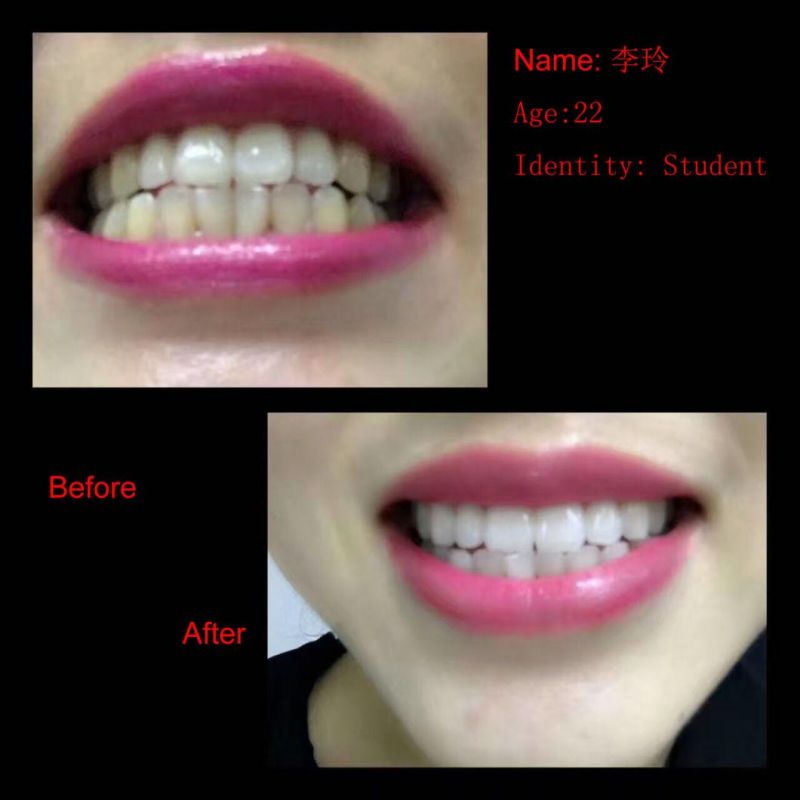 Teeth Whitening Kits Private Logo Dental Whitening