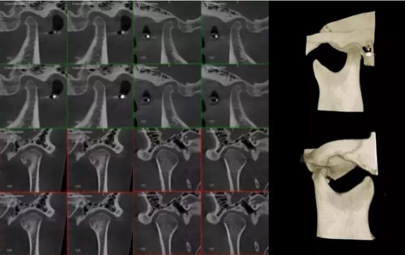 Hires 3D Dental Cbct Implant Inspection Equipment Implant Simulation Tmj Image New Cephalometric Seat Cbct