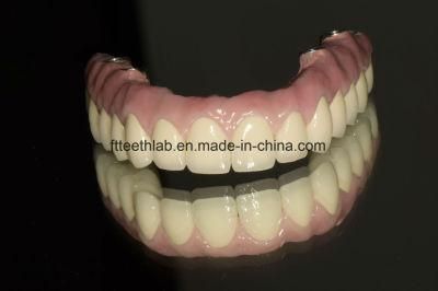 Dental Metal Ceramic Full Mouth Implant Rehabilitation