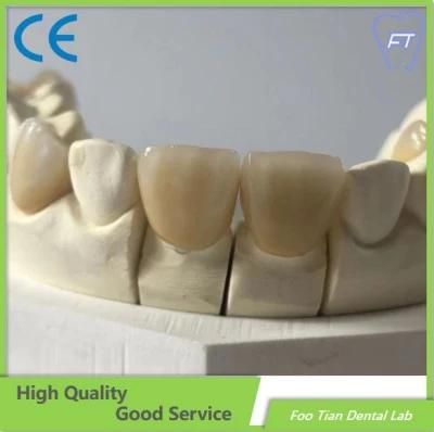 Emax Dental Inlays and Crowns with High Aesthetic Customized