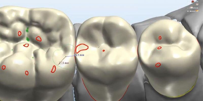 Dental Crown Bridge Veneer Metal Framework Implant Bar Design Service