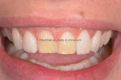 Active Smile Ultra Thin Cosmetic Dental Veneers