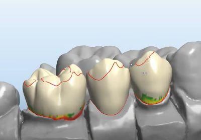 Dental Night Guard Splint Designer Smile Design Service