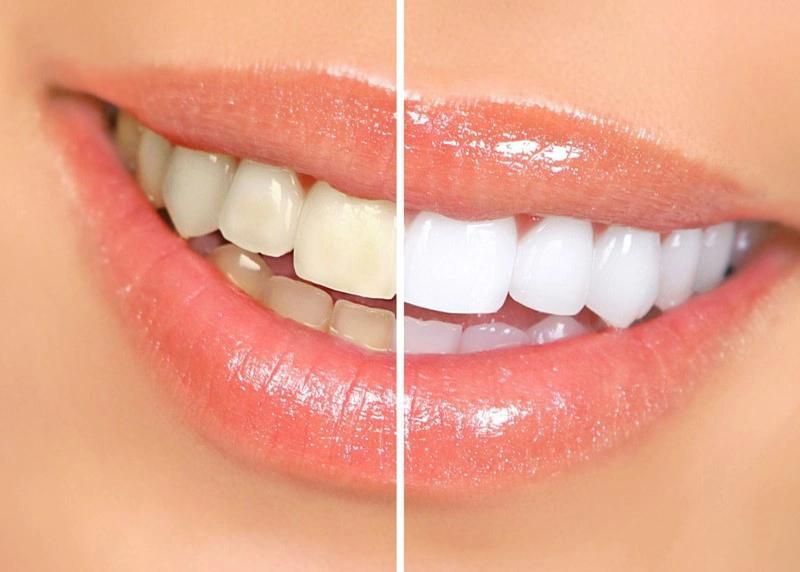 Dental Tooth Teeth Whitening Shade Guide